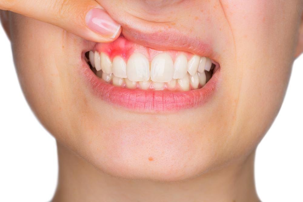 Gum disease treatment | family dentistry oak park mi