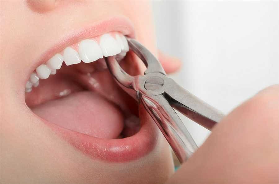 Teeth extraction by best dentist oak park